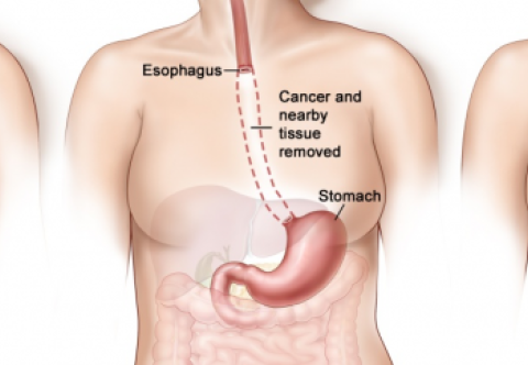 Điều trị đa mô thức trong ung thư thực quản được thực hiện như thế nào?